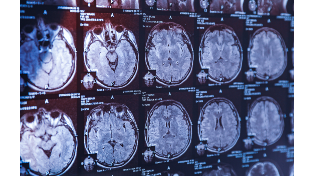 Concussion treatment 