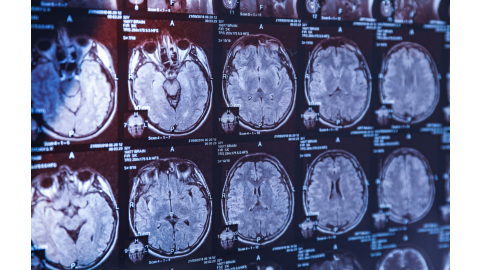 Therapy options for concussions