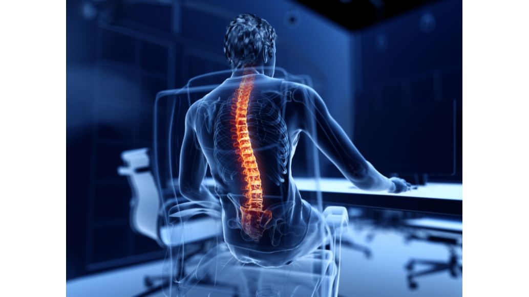 How to Treat Your Kyphosis: Exercises and Supports