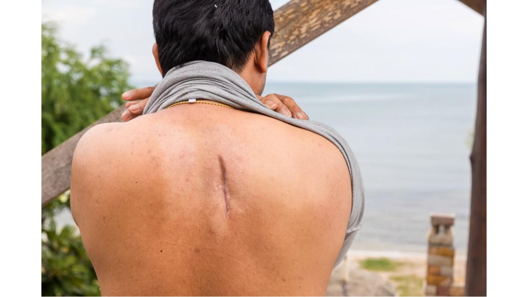 back scar