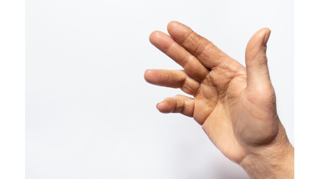 Hand with contractured third and fourth finger