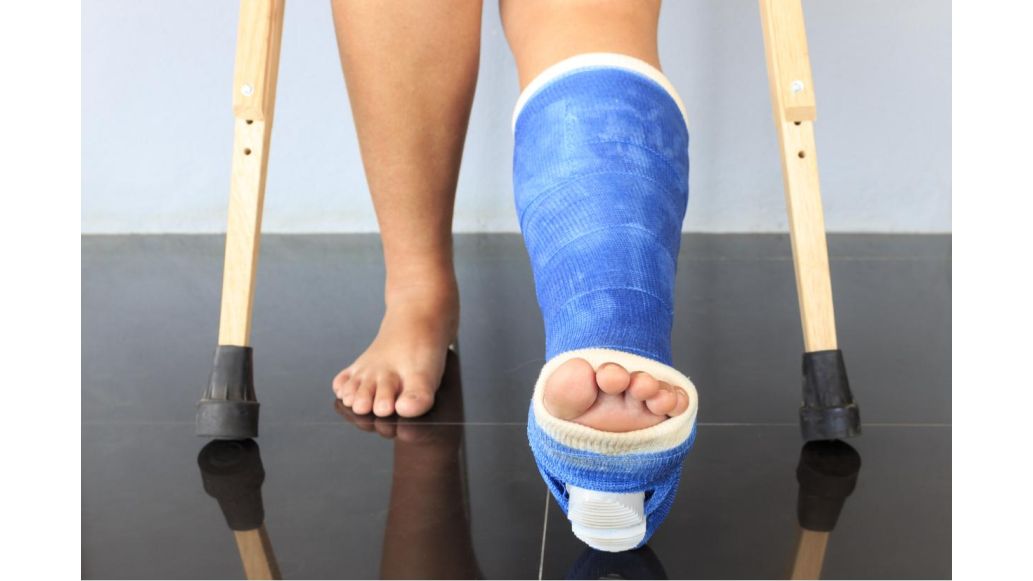 Photo of a broken leg in a blue plaster cast