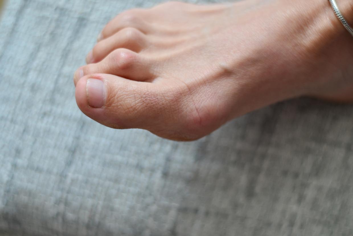 How to Prevent & Treat Hammer Toe