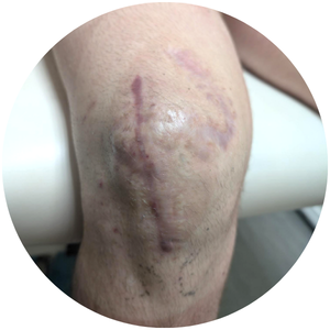 Scar appearance 2 months after the first LymphaTouch treatment