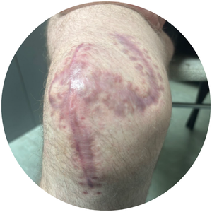 Scar appearance 5 weeks after removal of metal