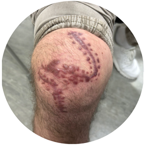 Baseline photo: how the scar looked before treatment began