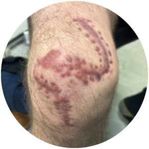 Scar appearance after 3 LymphaTouch sessions