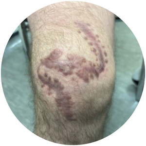 Scar appearance after 6 sessions with LymphaTouch