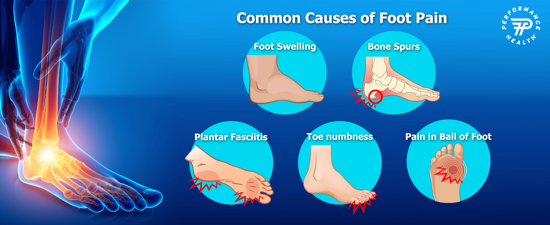 infographic of foot pain causes