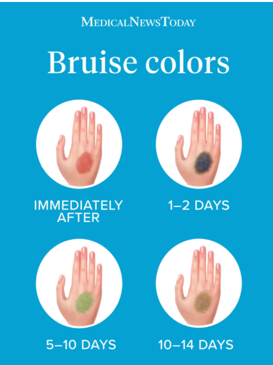 Infographic from Medical News Today with the 4 stages of bruise colors, ranging from immediately after to 10-14 days when the bruise is healing.