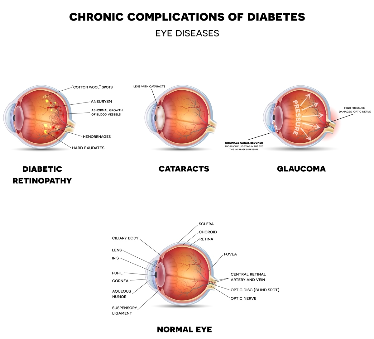 Chronic Complications of Diabetes
