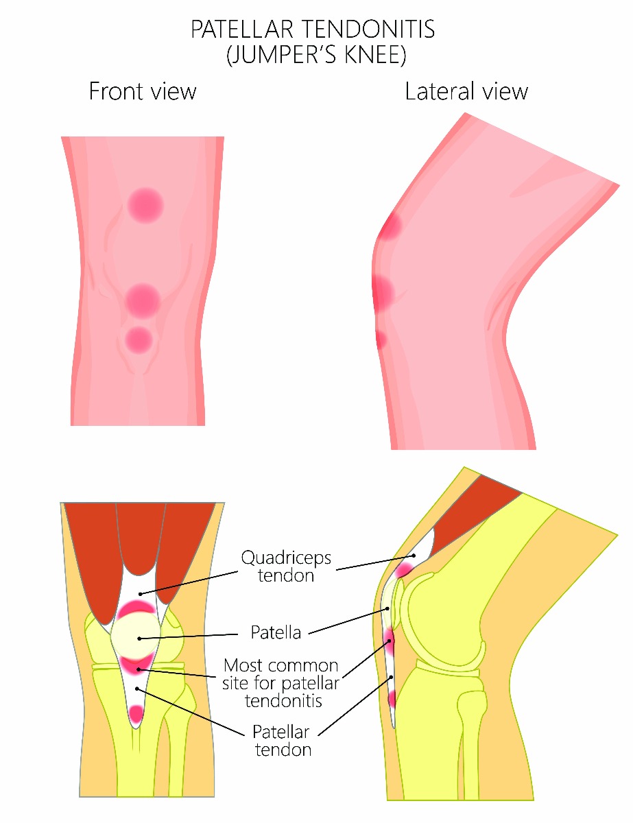 What Is Jumper S Knee And How To Treat It Performance Health What Is Jumper S Knee And How To Treat It Performance Health