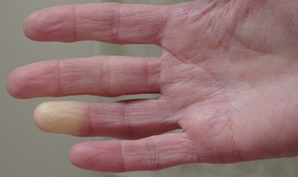 Raynauds Disease Close Up