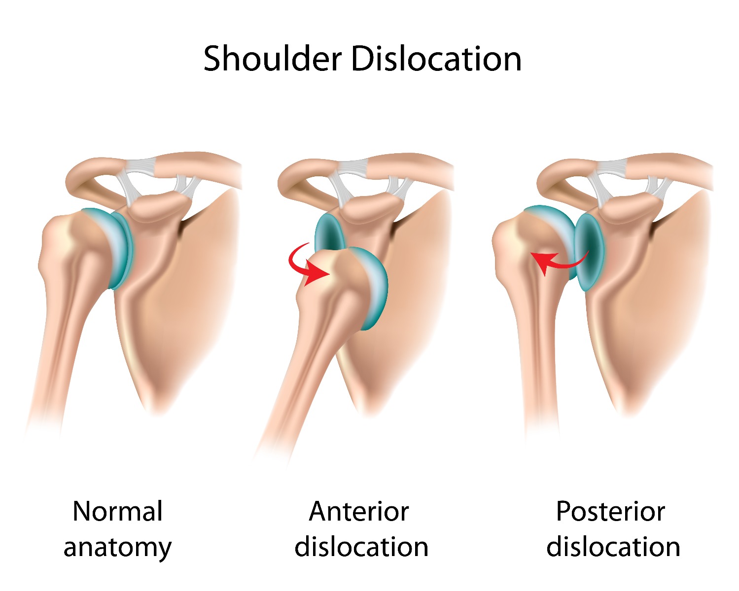 Treating Your Shoulder Dislocation and Preventing it in the Future