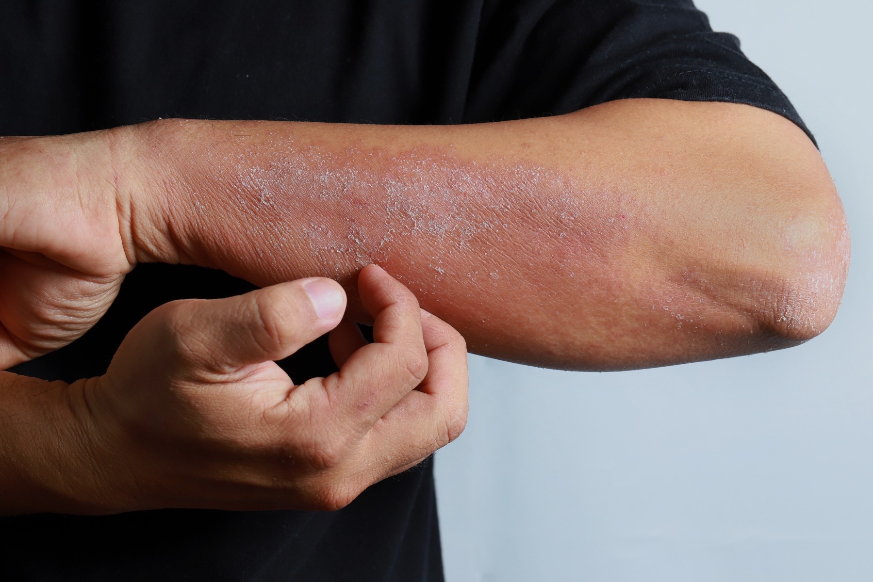 person scratching their arm