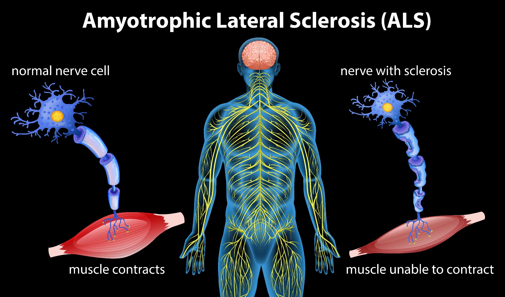 ALS nerve diagram