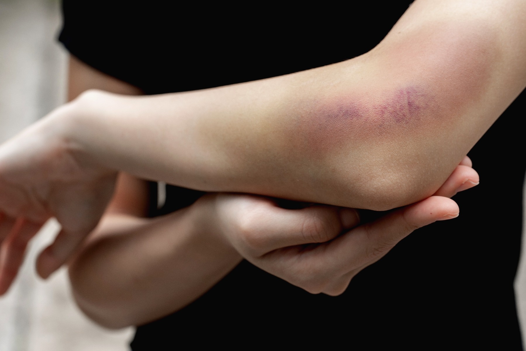 Person holding their arm, with large bruise seen above their elbow