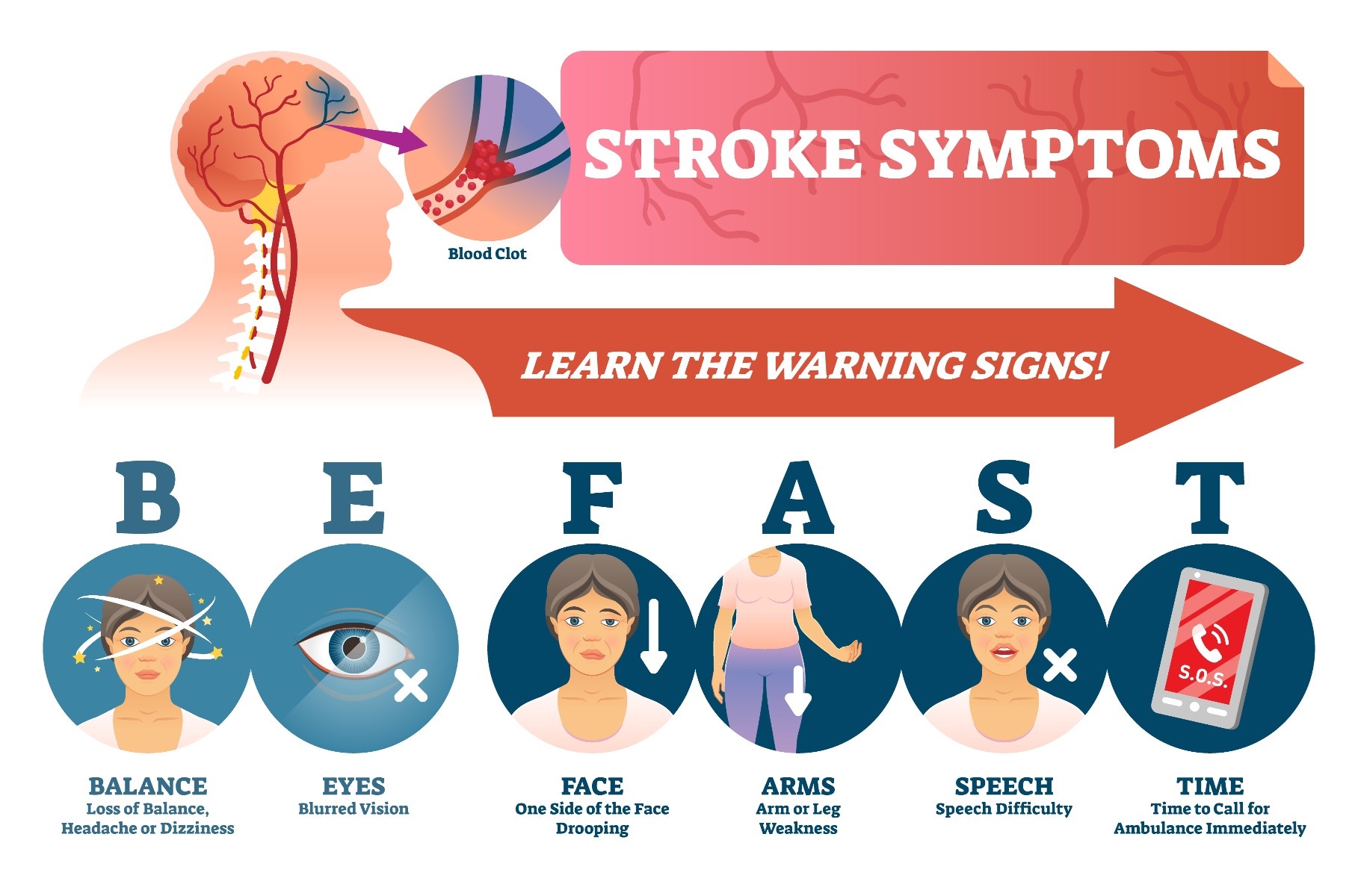 Infographic describing how you must Be Fast to respond to stroke symptoms