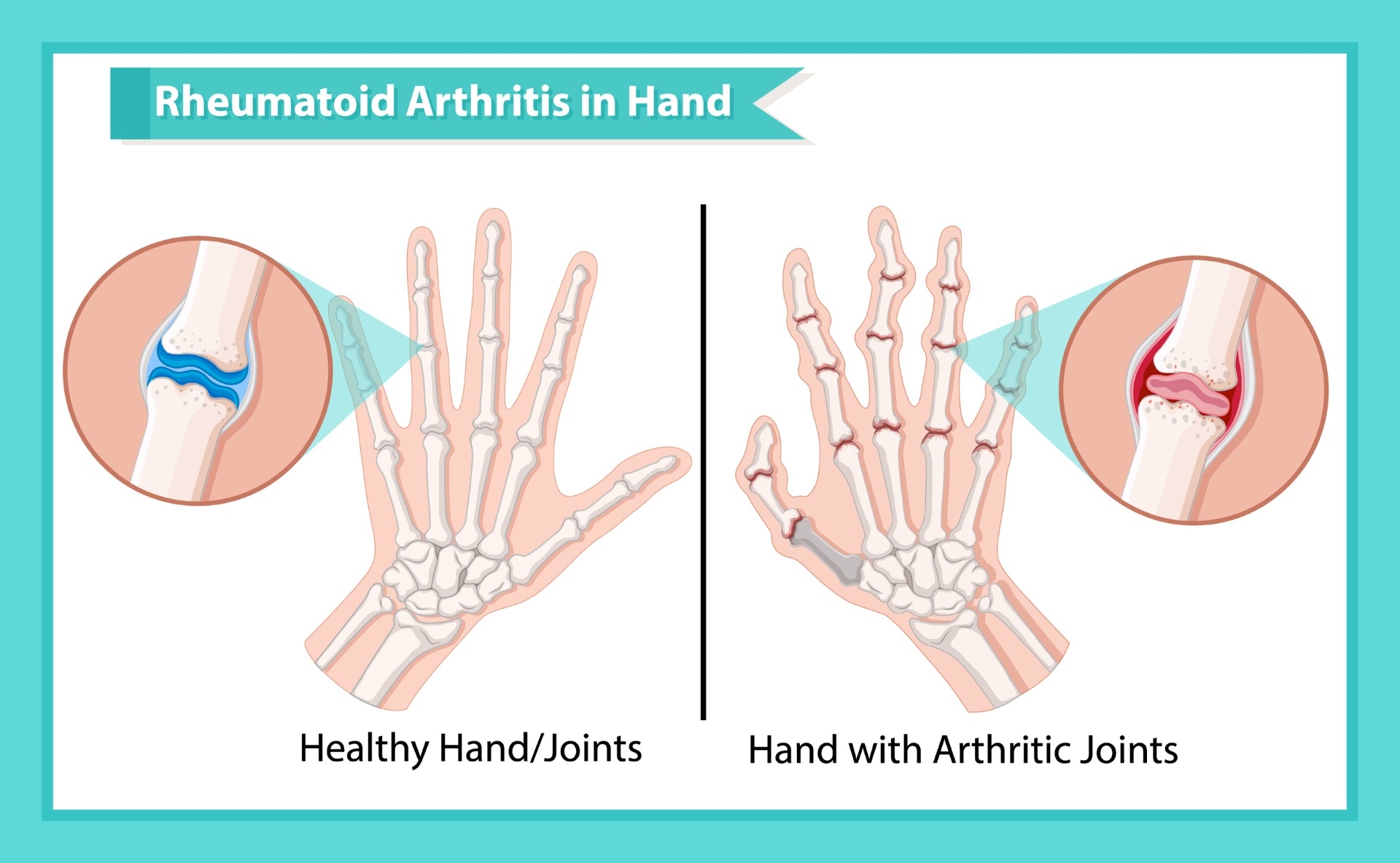 Carpal Tunnel Release  Johns Hopkins Medicine