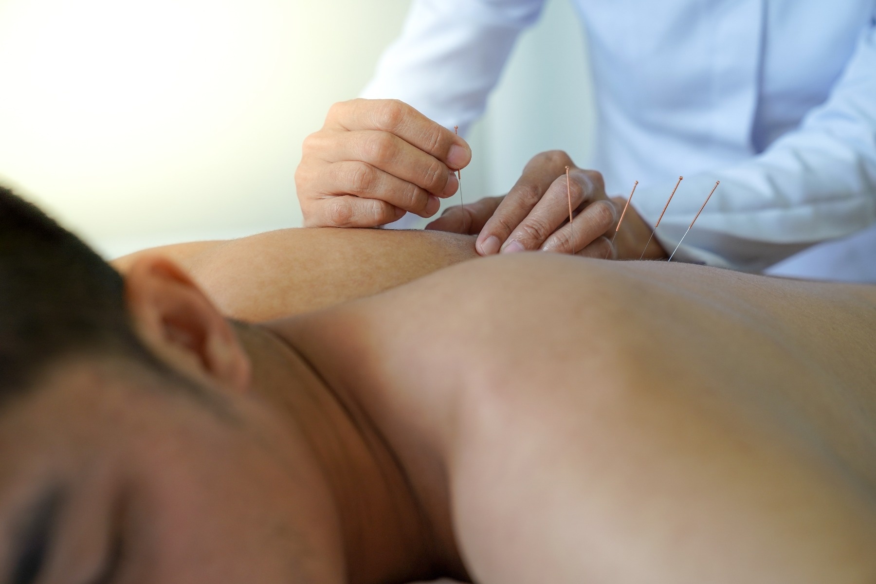Person laying down on stomach with practioner applying needles to their back to relieve pain