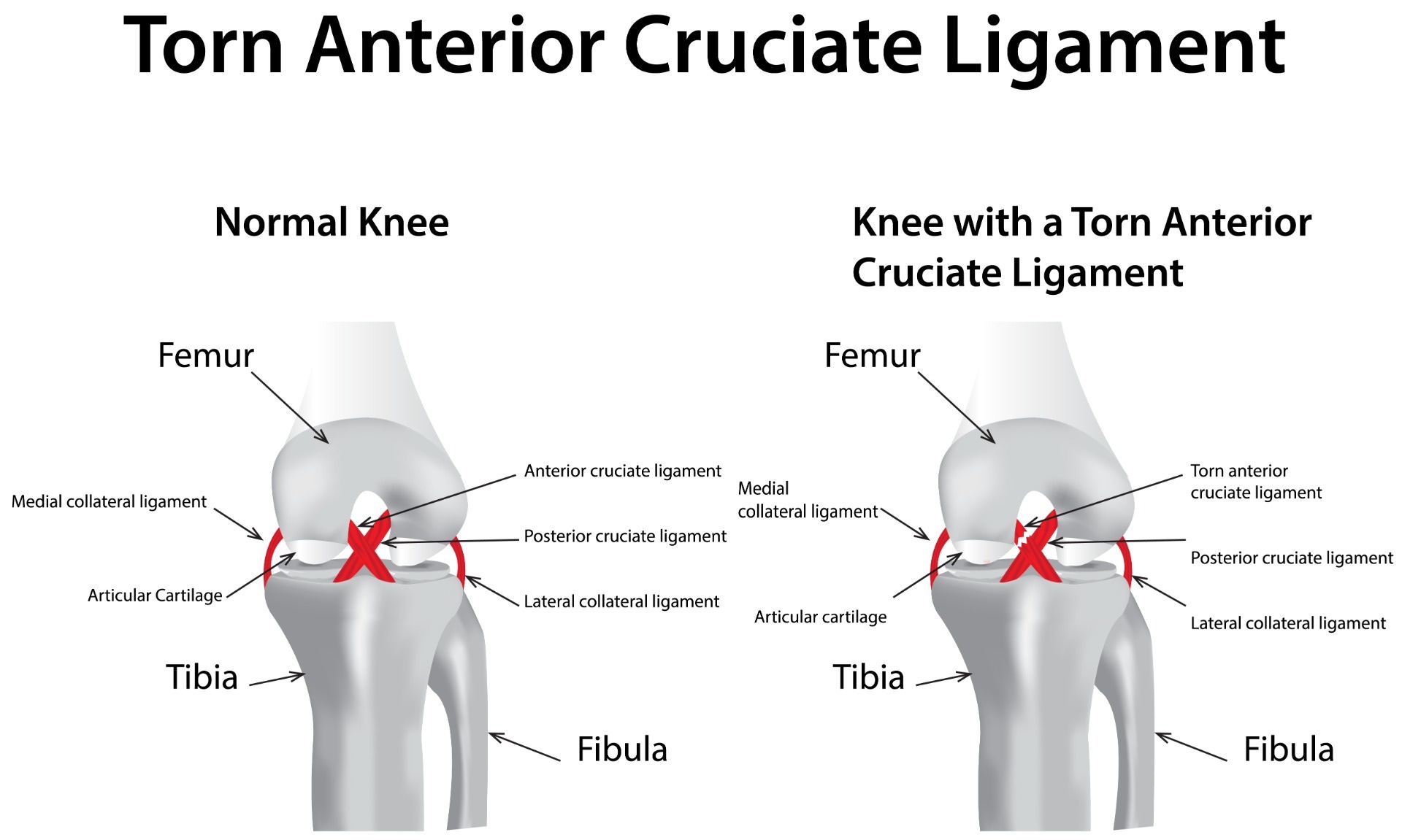 infographic of knee ligament and torn knee ligament