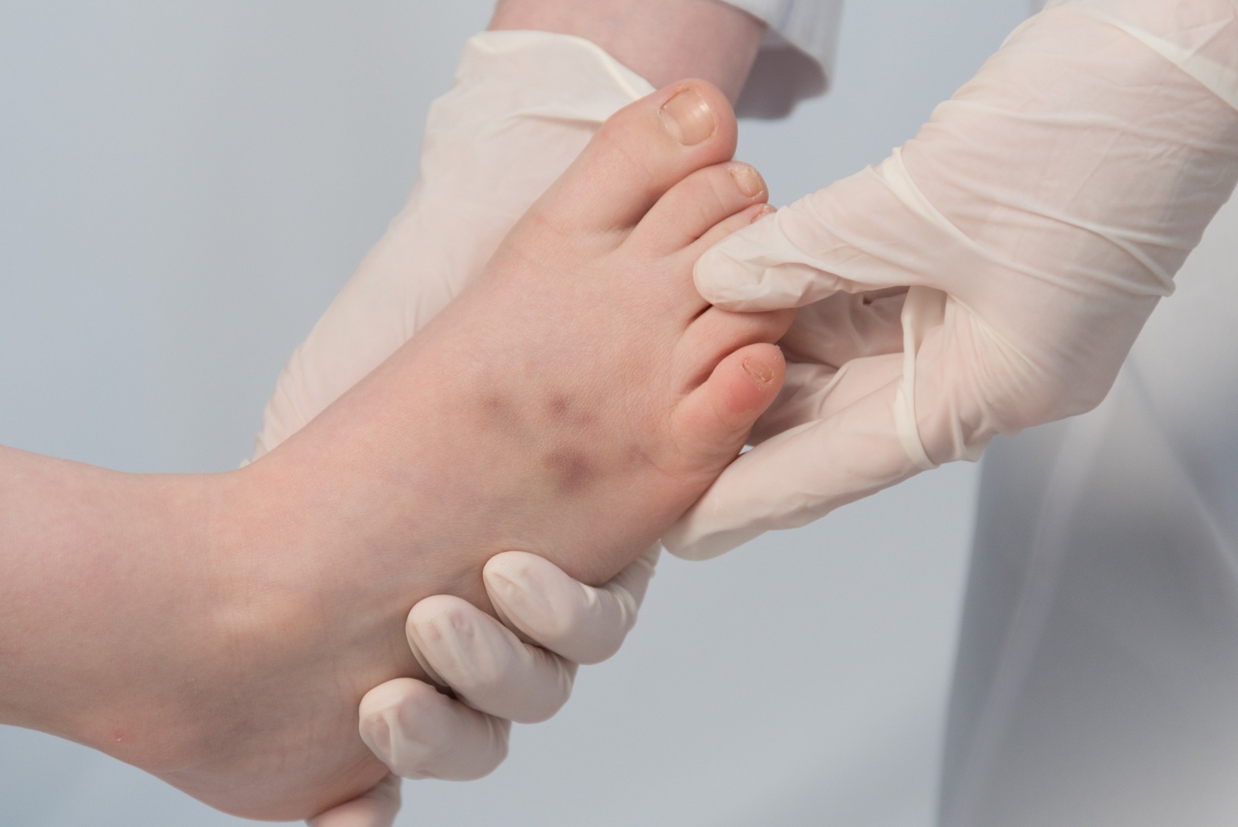 Medical professional with gloves on holding patient's foot, inspecting bruise on top of foot