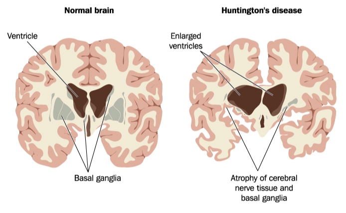 huntington's disease brain