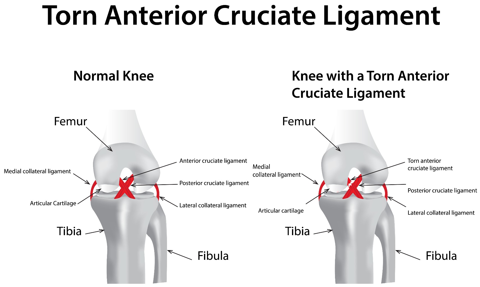 Anterior Cruciate Ligament Anatomy