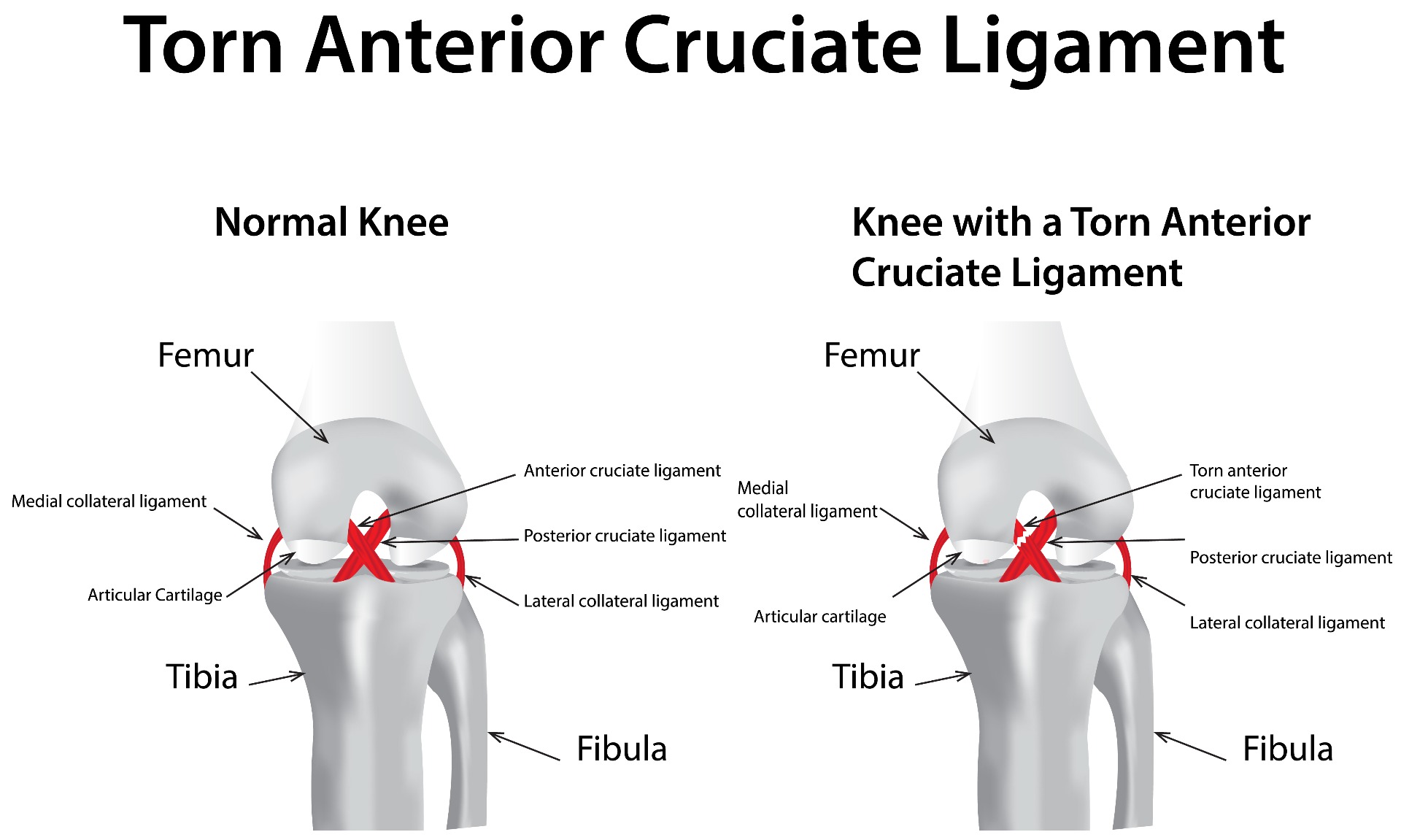 What Football Players Need to Know About ACL Injuries Performance Health