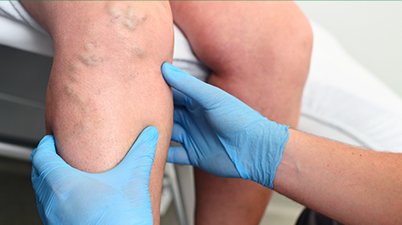 How to Treat Lymphedema