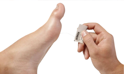 What Are Monofilaments? A Guide to Sensory Testing and Diabetic Foot Screening