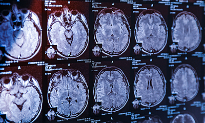 Red Light Therapy and Concussions
